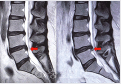 ▲ 요통 및 우측다리 통증을 호소하는 55세 여자환자로 부분 마취하고 고주파 내시경 치료술후 1개월 추시 MRI상 탈출된 디스크가 감압 및 수축된 소견 보임.