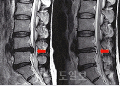 ▲ 요통 및 양측 다리 당김을 호소했던 65세 남자환자로 10분간의 최첨단 고주파 내시경 디스크 치료술후 척추신경을 누르던 추간판이 수축·응고되어 증상 없어짐.