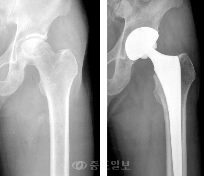 ▲ 엉덩이뼈 인공관절 수술전<왼쪽 사진>과 수술후 X-레이 모습.