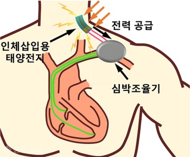 ▲ 피하에 삽입된 유연 인체삽입용 태양전지가 태양광을 통해 생성된 전기에너지를 이용하여 실제 사용되는 심박조율기에 전력을 공급하는 개념도. (사진제공=한국연구재단)
<br />