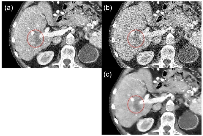 ▲ 인공지능을 이용한 저선량 X-ray CT 영상 복원