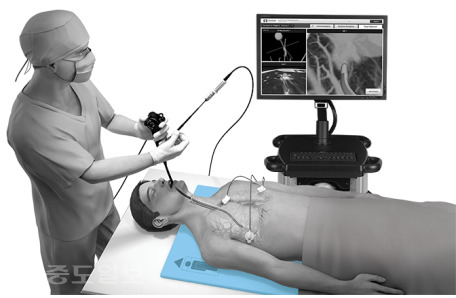 ▲ ENB 시술 장면.  환자 몸에 부착된 센서와 로케이션 보드, 영상 장비 등을 통해 카테터와 병소의 위치, 병변으로의 정확한 접근 여부 등을 시술의가 확인할 수 있다.