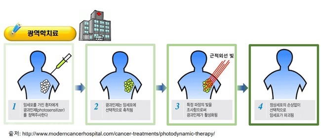 ▲ 임상에서 광역학 치료의 예