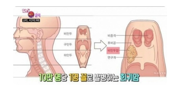 비인두암