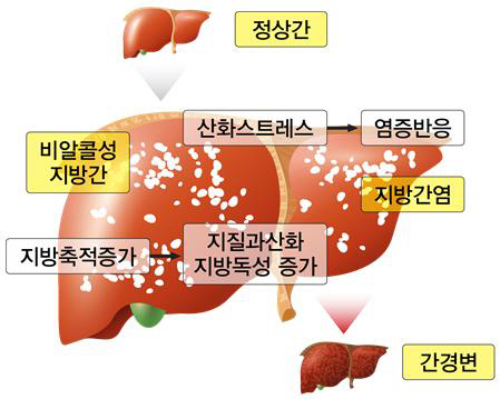 비알콜성지방간 생성 경로