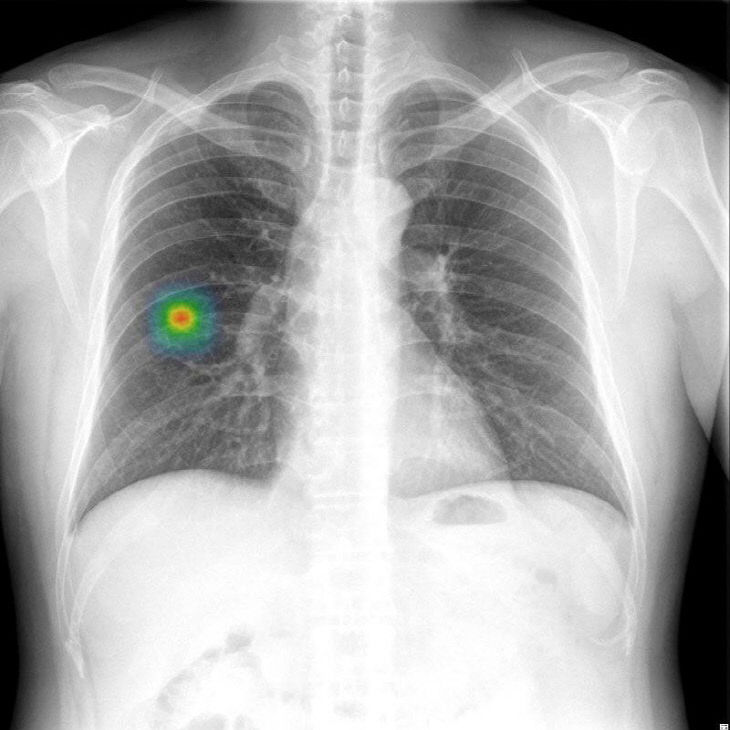 루닛 인사이트 CXR 흉부판독영상