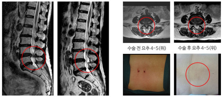 양방향 레이저