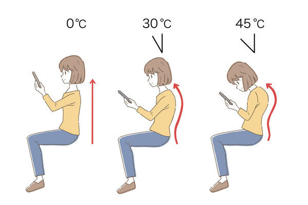 척추측만증 이미지