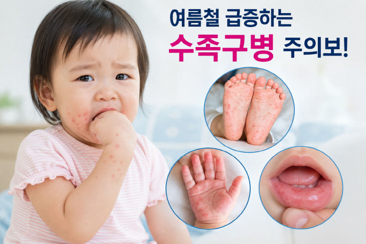 수족구병 유행 주의…