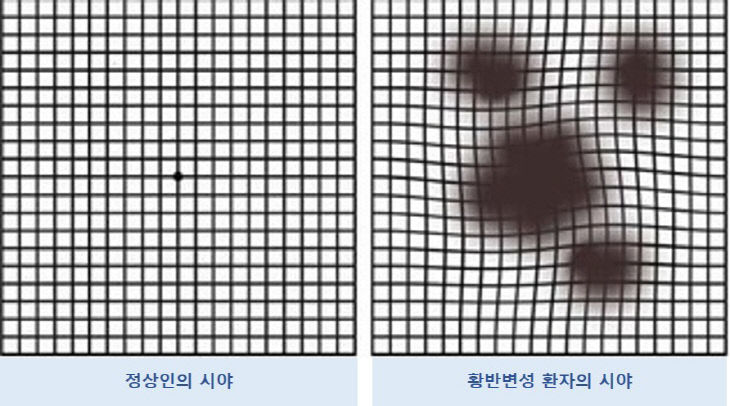 그림2_정상인과 황반변성 환자의시야